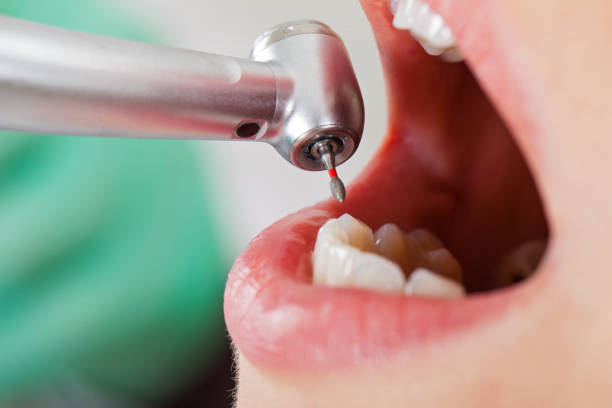 Best Dentist for Tooth Abscess  in Atmore, AL